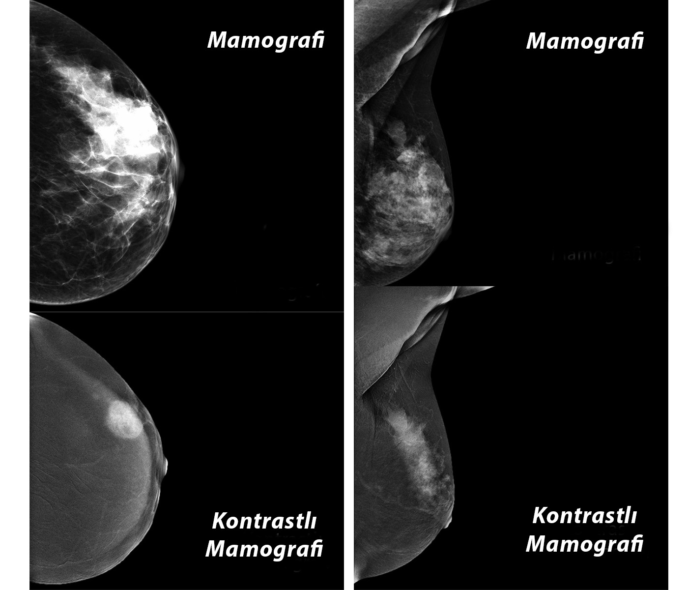 kontrastli mamografi