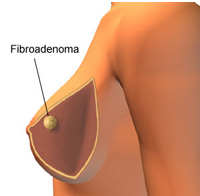 fibroadenoma